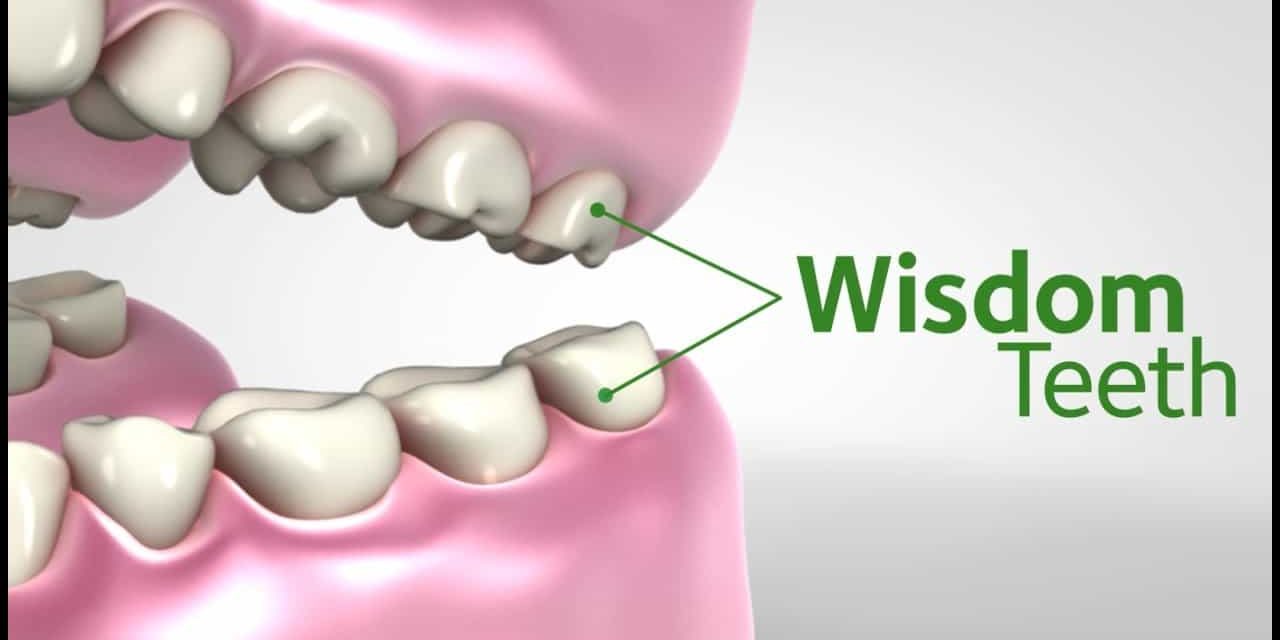 Different benefits of wisdom teeth removal